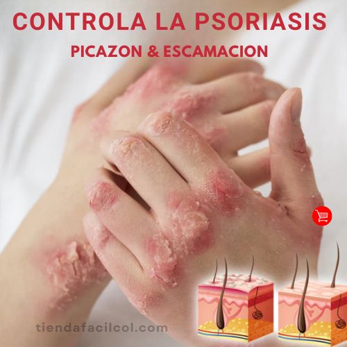 KOLMAX Dile Adiós a la Psoriasis: Alivio Instantáneo con Ingredientes Naturales 🌿✨