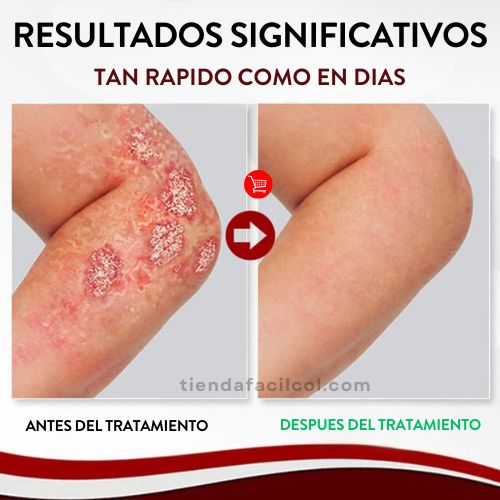 KOLMAX Dile Adiós a la Psoriasis: Alivio Instantáneo con Ingredientes Naturales 🌿✨