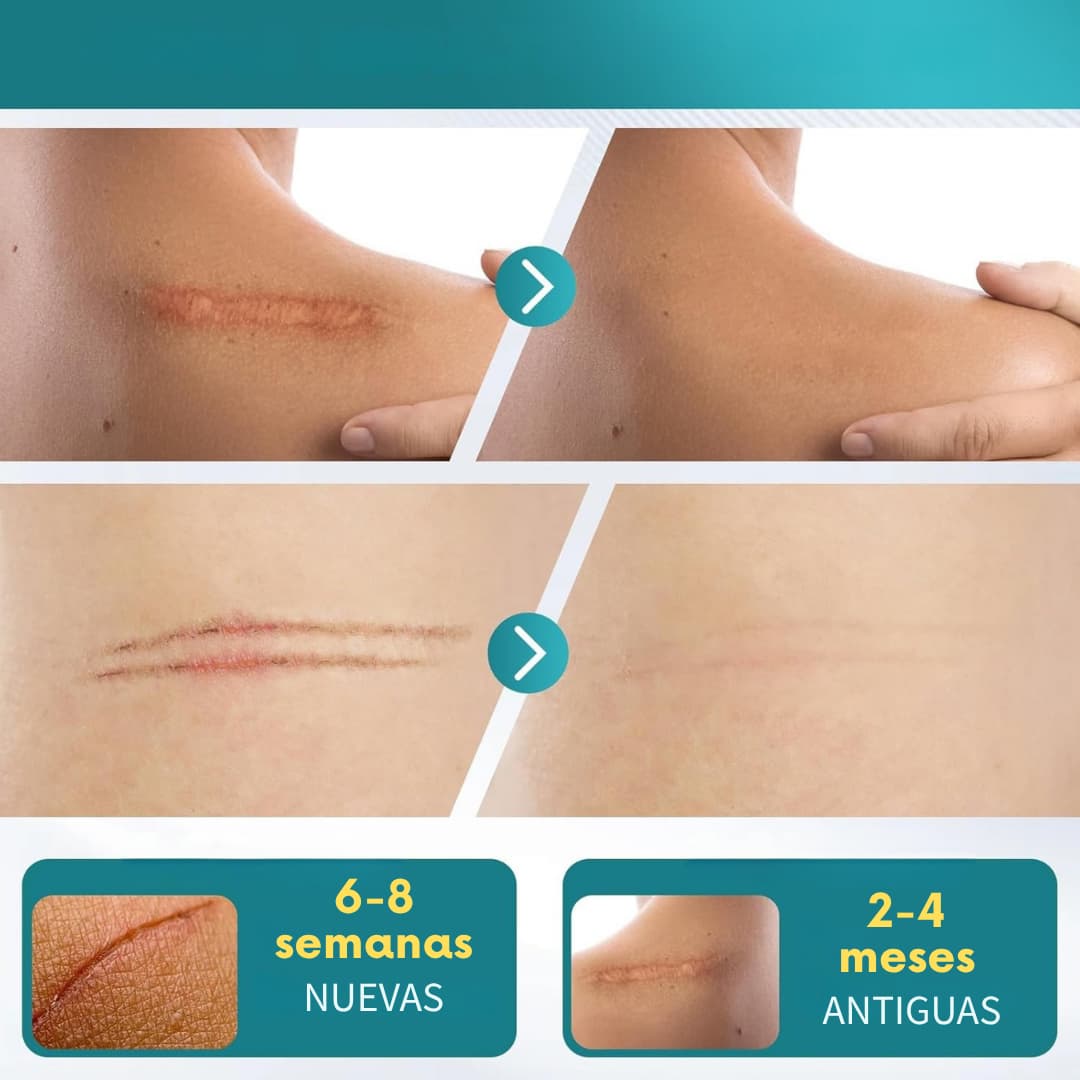 ELAIMEI🍃 Elimina cicatrices, arrugas, líneas de expresión de forma natural y sin dolor ¡PAGA 1️⃣ LLEVA 2️⃣👇!